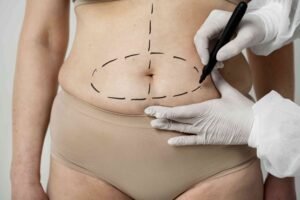 tummy tuck recovery 