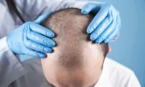 hair transplant steps