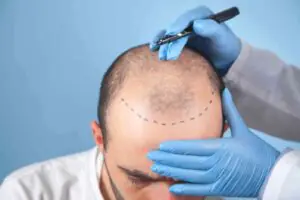 methods of hair transplant