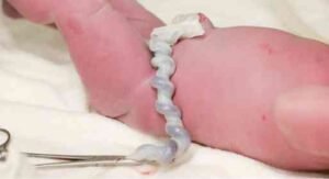 umbilical cord around neck