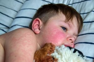 food allergies in infants